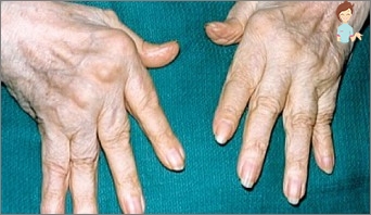 Élet rheumatoid arthritisszel
