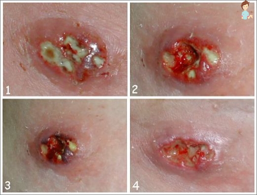 Zlatý Staphylococcus u dětí - symptomy, důvody, důsledky