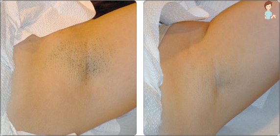 Laser hair removal