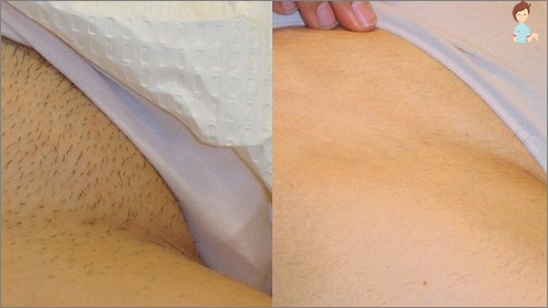 Laser hair removal - bikini zone