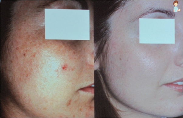 Tvář po ultrazvuk peeling - fotografie před a po