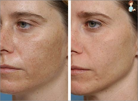 Tvář po ultrazvuk peeling - fotografie před a po