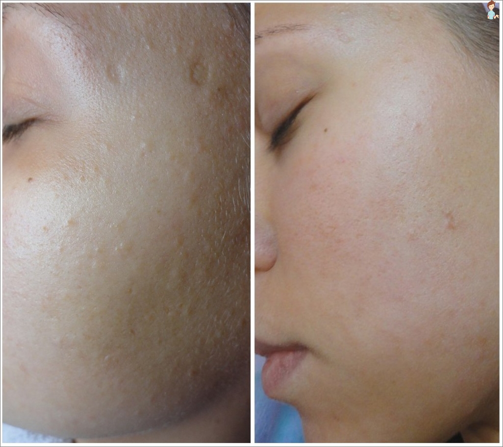 Tvář po ultrazvuk peeling - fotografie před a po