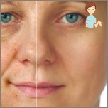 Chemische Peeling-Gesicht - Indikationen