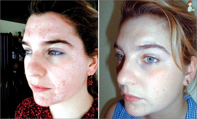 Chemische Peeling-Person - Foto vor und nach