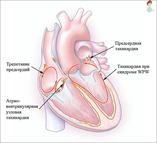 Všechny příčiny tachykardie - zobrazení