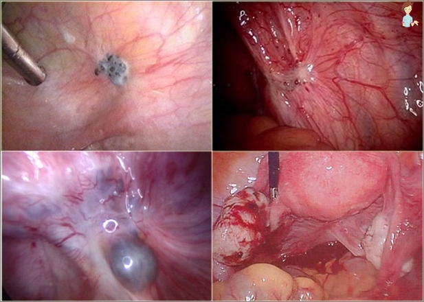 Endometrióza