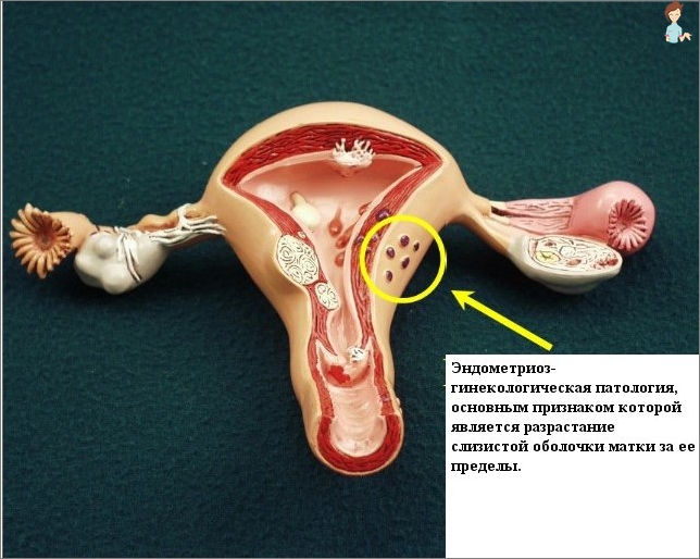 Endometrióza