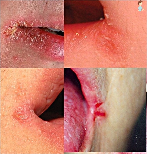 Ursachen für Risse in den Ecken der Lippen