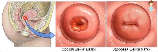 Simptomele eroziunii colului uterin