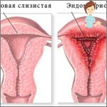Cauzele infertilității feminine