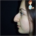 Indikace pro Rhinoplasty