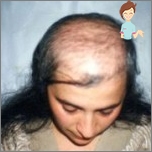 Androgenetická alopecie