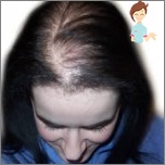 Androgenetická alopecie