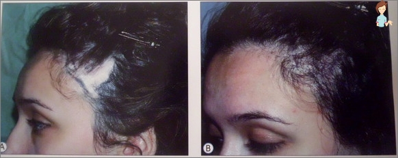 Выпадают волосы после операции. Дарсонваль алопеция андрогенная. Облысение у женщин до и после.