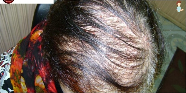 Alopecie