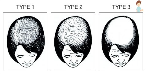 Androgenní alopecie