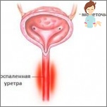Chronische Urethritis bei Frauen