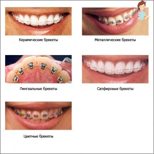 What braces worth putting a child and when?