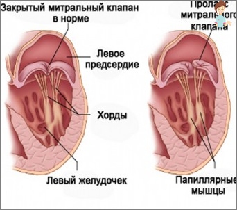 Další akord v srdci dítěte: Příčiny, symptomy, diagnostika a léčba