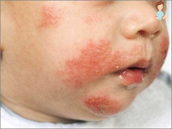 كيف تكشف وعلاج التهاب الجلد التحسسي في الأطفال؟
