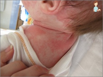 إشارة الجلد في الطفل: الأعراض والعلاج