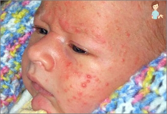Akne in Neugeborenen: Arten, Ursachen des Aussehens, Behandlung