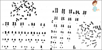 Karyotyping: Co je to za to, co je jmenováno a jak ovlivňuje těhotenství?