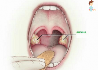 Tratamiento de los antibióticos del dolor de garganta