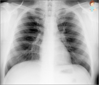 Symptomy a léčba bronchopneumonie