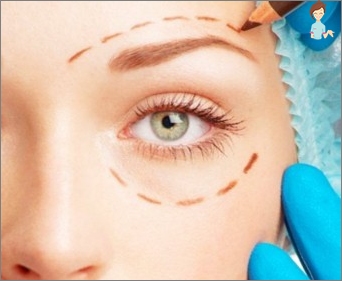 Blepharoplasty