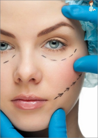 Blepharoplasty