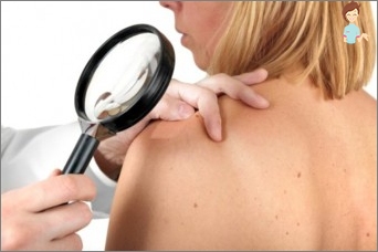 شعبية حول سرطان الجلد