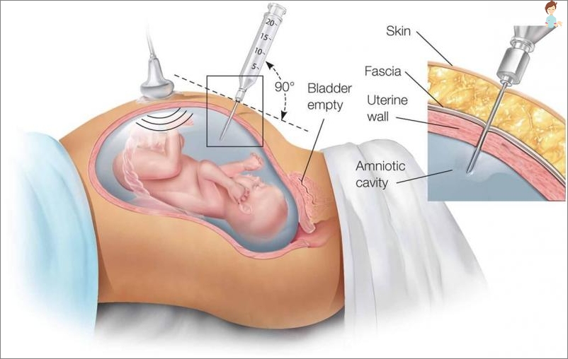 Amniocentéza s multi-way