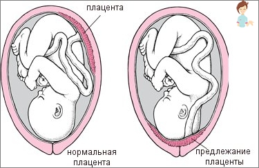 Переднее предлежание плаценты