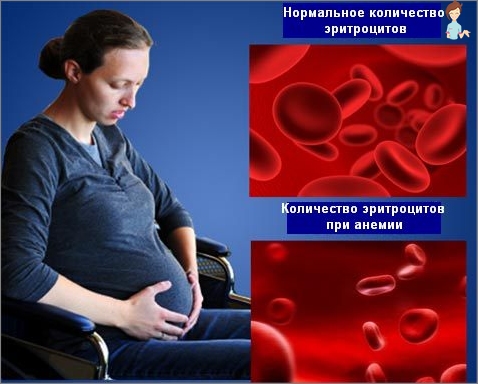 Ursachen, Grade der Eisenmangelanämie während der Schwangerschaft