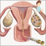 Intrauterinní inseminace