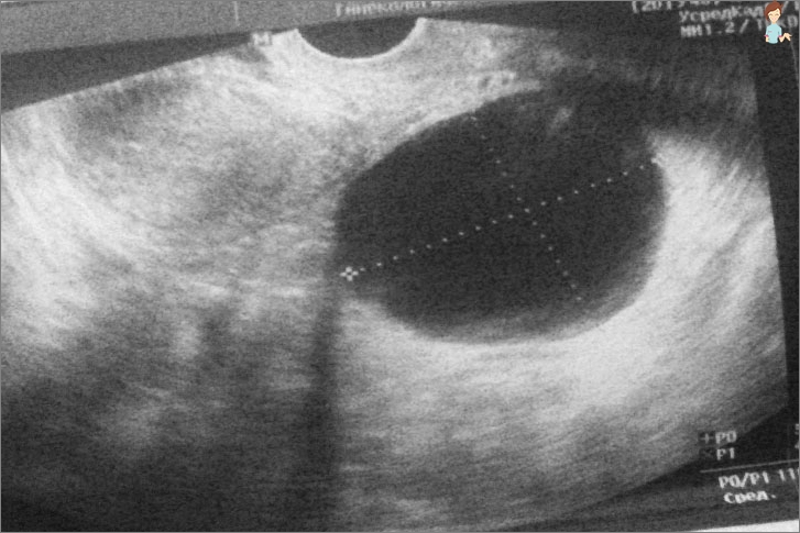 Ovariala polichistică și sarcină