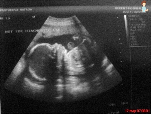 Ultraschall ein Kind um 25 Wochen