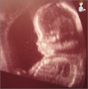 Ultraschall in der 23-Woche Schwangerschaft