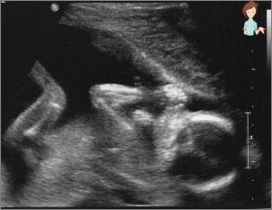 Ultraschall 18 Wochen Schwangerschaft