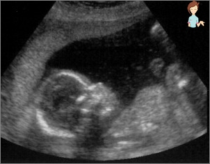 Ultraschall 19 Schwangerschaftswoche
