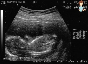 الموجات فوق الصوتية 15 أسبوع من الحمل