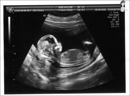 الموجات فوق الصوتية في الأسبوع الثالث عشر من الحمل. صورة فوتوت