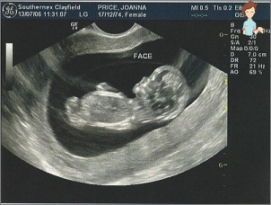 Sarcina 11 săptămâni - ultrasunete
