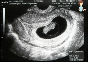 Ultraschall für einen Zeitraum von 9 Wochen Schwangerschaft