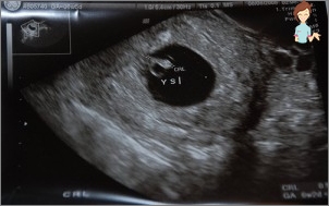 Ultraschall 6 Wochen Schwangerschaft