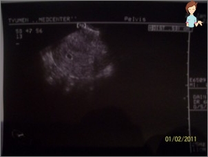 Ultraschall -5 Wochen Schwangerschaft