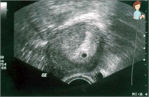 Schwangerschaft 4 Wochen - Ultraschall
