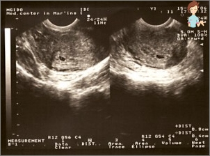 Ultraschall in der 3. Schwangerschaftswoche